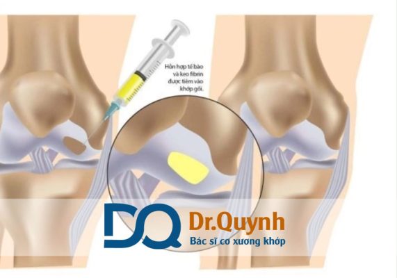 Ai nên tiêm huyết tương giàu tiểu cầu để điều trị khớp gối? Tiêm huyết tương giàu tiểu cầu (PRP) là phương pháp điều trị hiện đại, giúp phục hồi mô tổn thương và giảm đau khớp gối một cách tự nhiên.
