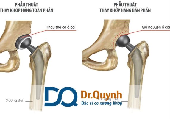 Mức chi phí thay khớp háng trong các chương trình bảo hiểm sức khỏe Mức chi phí thay khớp háng luôn là mối quan tâm hàng đầu của bệnh nhân và người nhà khi đứng trước quyết định phẫu thuật.