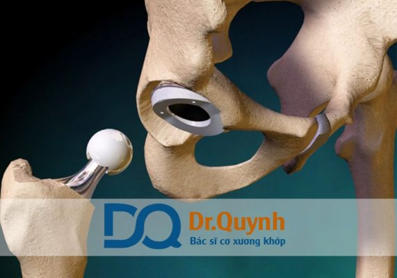 Thay khớp háng và các dịch vụ vật lý trị liệu sau phẫu thuật Thay khớp háng là một trong những thành tựu quan trọng của y học hiện đại, mang lại hy vọng mới cho hàng ngàn bệnh nhân mỗi năm tại Việt Nam.