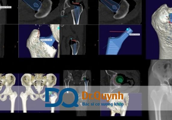 Chi phí thay khớp háng ở bệnh viện Vinmec so với bệnh viện khác Chi phí thay khớp háng ở bệnh viện Vinmec là mối quan tâm hàng đầu của bệnh nhân và người nhà khi cân nhắc lựa chọn nơi điều trị.