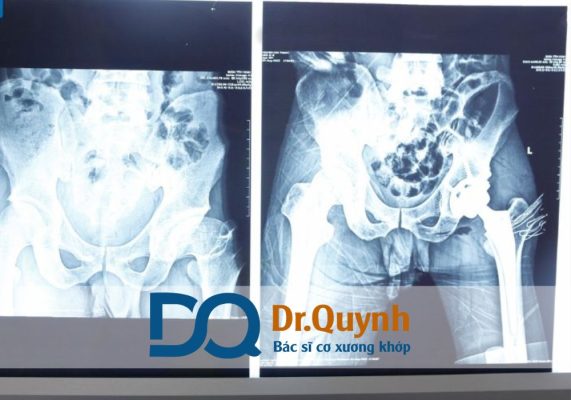 Thay khớp háng có bảo hành không? Những thông tin về bảo hành khớp háng Một số bệnh viện lớn hoặc các bác sĩ chuyên khoa uy tín như CHUYÊN GIA, BÁC SĨ CKI LÊ VĂN QUỲNH có thể cam kết theo dõi trọn đời, tư vấn và xử lý biến chứng kịp thời cho bệnh nhân.