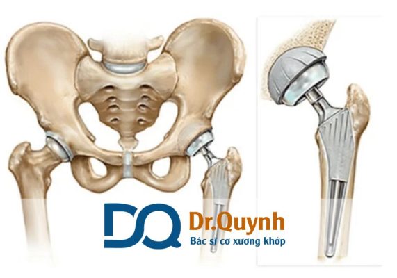 Tư vấn chi phí thay khớp háng cho người mắc bệnh lý xương khớp Chi phí thay khớp háng phụ thuộc vào loại khớp, bệnh viện, tay nghề bác sĩ, và cả chế độ bảo hiểm.