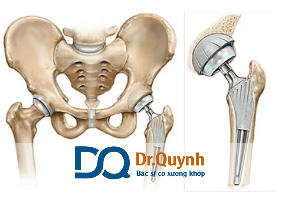 Chi phí thay khớp háng phụ thuộc vào loại khớp, bệnh viện, tay nghề bác sĩ, và cả chế độ bảo hiểm.