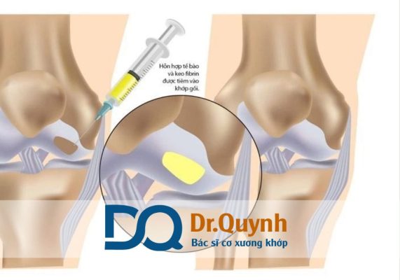 Tiêm huyết tương giàu tiểu cầu trong phục hồi chấn thương thể thao Nếu bạn quan tâm đến chi phí hoặc muốn được tư vấn trực tiếp, hãy liên hệ với CHUYÊN GIA, BÁC SĨ CKI LÊ VĂN QUỲNH – chuyên gia hàng đầu trong điều trị PRP.
