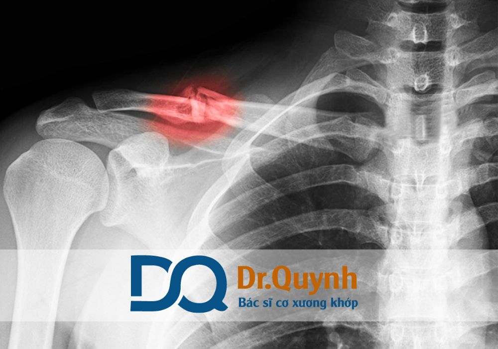 Để hạn chế tối đa biến chứng và rút ngắn thời gian hồi phục, người bệnh nên đến thăm khám tại các phòng khám uy tín ngay khi có triệu chứng đau nhức, sưng viêm, hạn chế vận động. Tránh tự ý dùng thuốc hoặc xoa bóp tại nhà khi chưa có chỉ định.