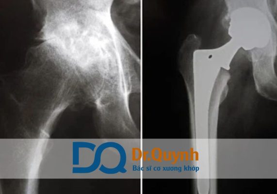 Thay khớp háng và các dịch vụ vật lý trị liệu sau phẫu thuật Theo chia sẻ của CHUYÊN GIA, BÁC SĨ CKI LÊ VĂN QUỲNH, “Một ca thay khớp háng thành công không chỉ nằm ở ca mổ, mà còn nằm ở hành trình phục hồi sau đó.