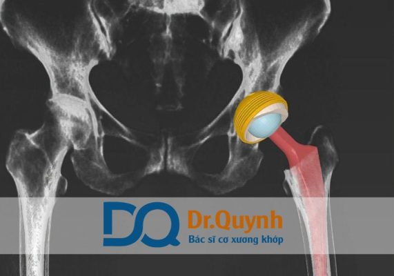 Chi phí thay khớp háng ở bệnh viện Vinmec so với bệnh viện khác ới những bệnh nhân cần tư vấn cá nhân hóa, nên tìm đến các chuyên gia nhiều kinh nghiệm như CHUYÊN GIA, BÁC SĨ CKI LÊ VĂN QUỲNH để được đánh giá chi tiết tình trạng và lựa chọn phương án phù hợp.