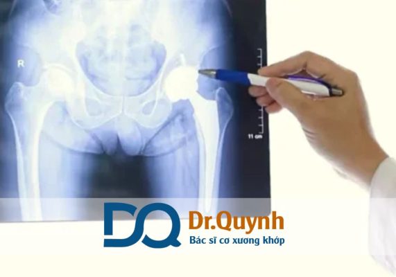 Thay khớp háng có bảo hành không? Những thông tin về bảo hành khớp háng Một số bệnh viện quốc tế hoặc phòng khám uy tín sẽ hỗ trợ thủ tục làm việc với hãng sản xuất để giảm thiểu chi phí thay khớp háng cho bệnh nhân (xem thêm tại: drquynh.com/chi-phi-thay-khop-hang).