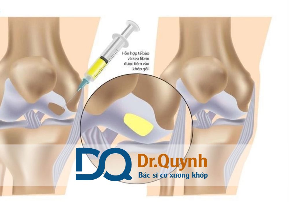 Tiêm huyết tương giàu tiểu cầu (PRP) là phương pháp điều trị hiện đại, an toàn, có khả năng tái tạo mô và cải thiện chức năng lâu dài.