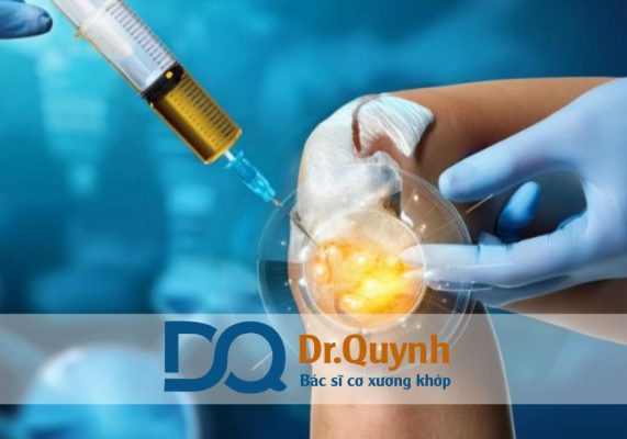 Hiệu quả lâu dài của tiêm huyết tương giàu tiểu cầu Hiệu quả lâu dài của tiêm huyết tương giàu tiểu cầu (PRP) là điều khiến nhiều bệnh nhân quan tâm khi cân nhắc lựa chọn phương pháp này.