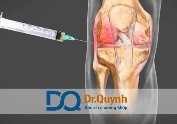 Tiêm huyết tương giàu tiểu cầu có tác dụng phụ gì không? Tiêm huyết tương giàu tiểu cầu (PRP) ngày càng được ứng dụng rộng rãi trong điều trị bệnh lý cơ xương khớp, đặc biệt là khớp gối, vai, cột sống và chấn thương thể thao.