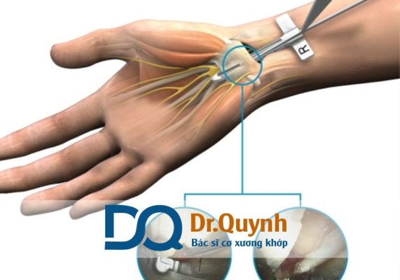 Chi phí mổ hội chứng ống cổ tay ở bệnh viện Chấn thương chỉnh hình Chi phí mổ hội chứng ống cổ tay ở Bệnh viện Chấn thương Chỉnh hình luôn là thắc mắc lớn đối với nhiều người khi có chỉ định phẫu thuật.