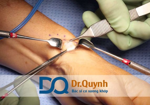 Mổ hội chứng ống cổ tay là phương pháp điều trị được áp dụng khi các biện pháp bảo tồn không còn hiệu quả, giúp giải phóng thần kinh giữa bị chèn ép.