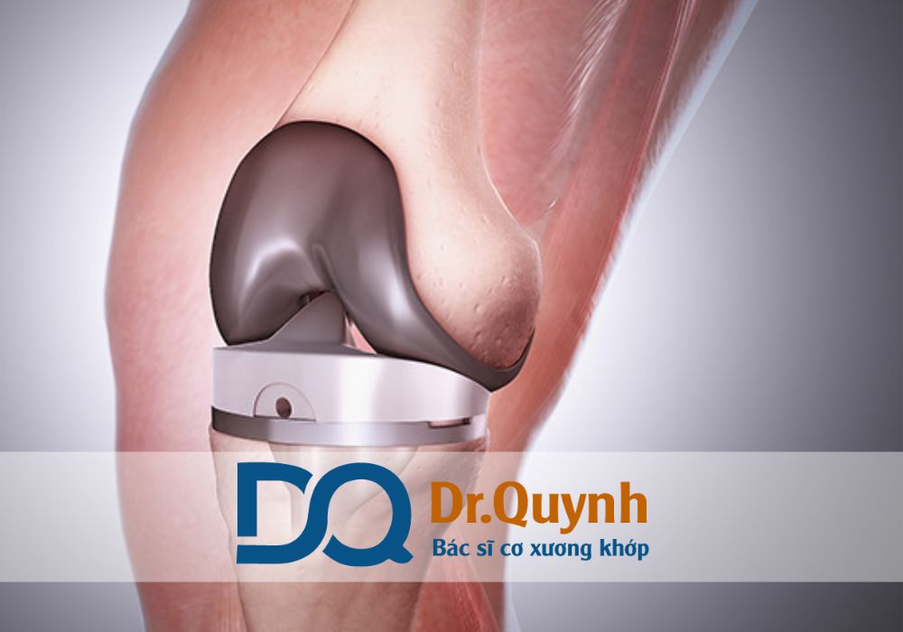Nếu bạn ở miền Bắc và cần phẫu thuật thay khớp gối an toàn, chất lượng, Bệnh viện Việt Đức là lựa chọn hàng đầu.