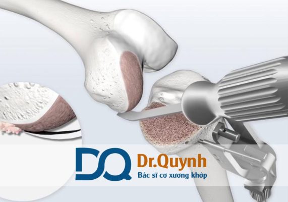 Review thay khớp gối ở bệnh viện Nam Sài Gòn! Hướng dẫn quy trình thủ tục mổ Nam Sài Gòn ngày càng khẳng định vị thế trong lĩnh vực thay khớp gối tại TP.HCM.