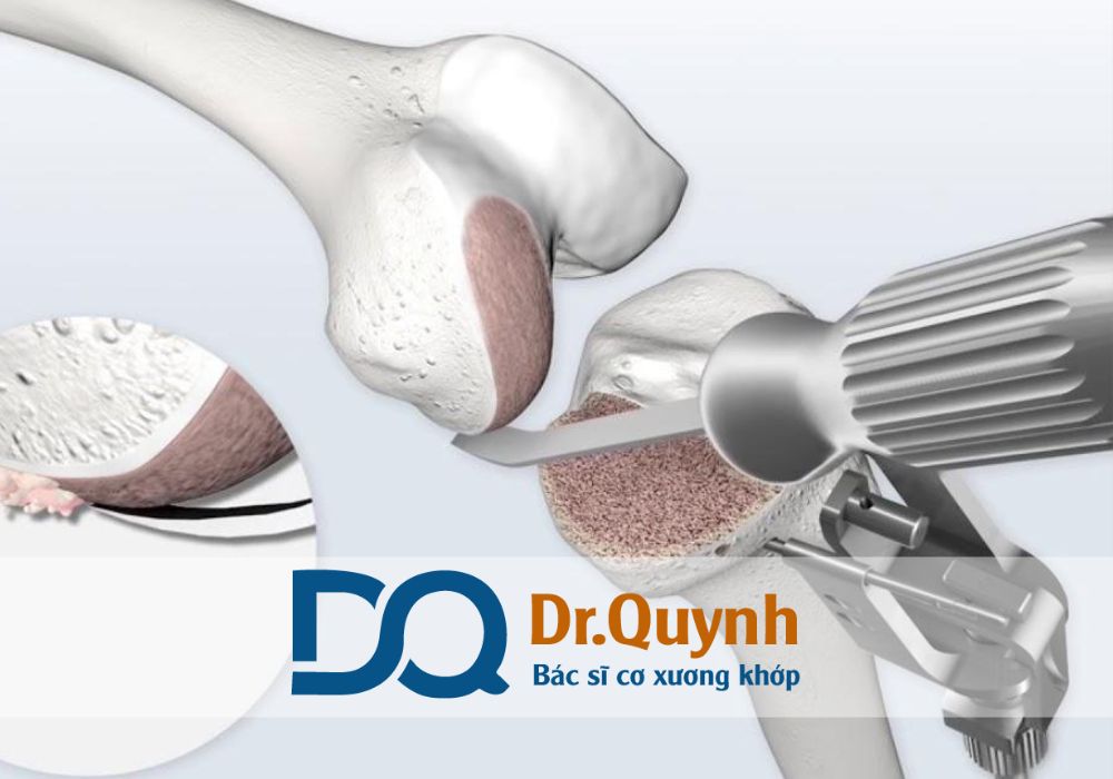 Nam Sài Gòn ngày càng khẳng định vị thế trong lĩnh vực thay khớp gối tại TP.HCM.
