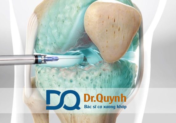 Tiêm chất nhờn khớp gối giá bao nhiêu? Đây được xem là giải pháp trung gian, vừa giúp giảm đau, cải thiện khả năng vận động, vừa trì hoãn phẫu thuật thay khớp gối trong nhiều trường hợp.