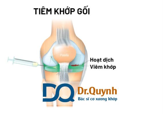 Tiêm chất nhờn khớp gối có tốt không? Tiêm chất nhờn khớp gối có tốt không là câu hỏi được rất nhiều bệnh nhân mắc thoái hóa khớp gối quan tâm