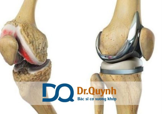Thay khớp gối ở bệnh viện nam sài gòn có được hưởng BHYT không? Mức hưởng bao nhiêu Thay khớp gối là một trong những phẫu thuật chỉnh hình phổ biến nhất hiện nay, đặc biệt với bệnh nhân bị thoái hóa khớp gối giai đoạn cuối, viêm khớp dạng thấp nặng hoặc chấn thương nghiêm trọng.