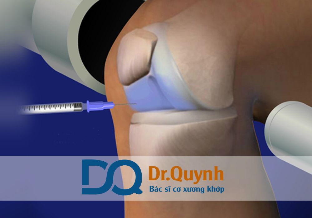 Đây là giải pháp an toàn, hiệu quả cho bệnh nhân thoái hóa khớp gối mức độ nhẹ và trung bình.