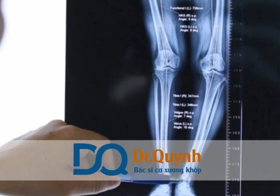 Thay khớp gối ở bệnh viện nam sài gòn có được hưởng BHYT không? Mức hưởng bao nhiêu Việc được hưởng BHYT khi phẫu thuật là mối quan tâm lớn của người bệnh và gia đình