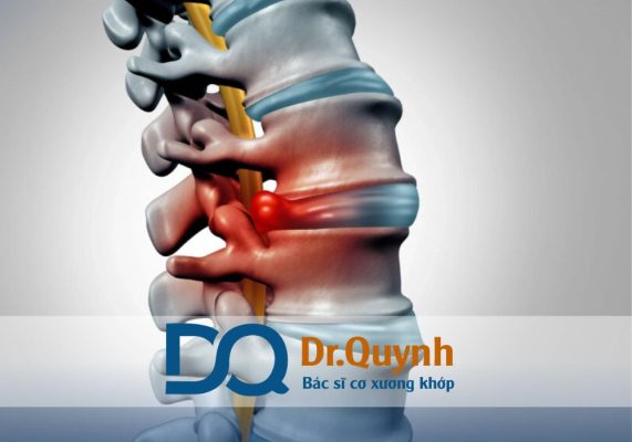 Tiêm huyết tương giàu tiểu cầu cho thoát vị đĩa đệm Tiêm huyết tương giàu tiểu cầu cho thoát vị đĩa đệm đang dần trở thành một trong những phương pháp hỗ trợ điều trị tiên tiến, an toàn và mang lại hiệu quả lâu dài