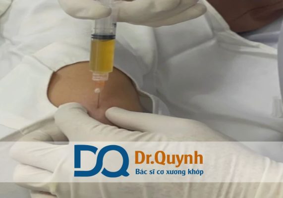Tiêm huyết tương giàu tiểu cầu có khả năng hỗ trợ tái tạo sụn khớp ở mức độ nhất định, nhất là trong giai đoạn sớm và trung bình của thoái hóa.