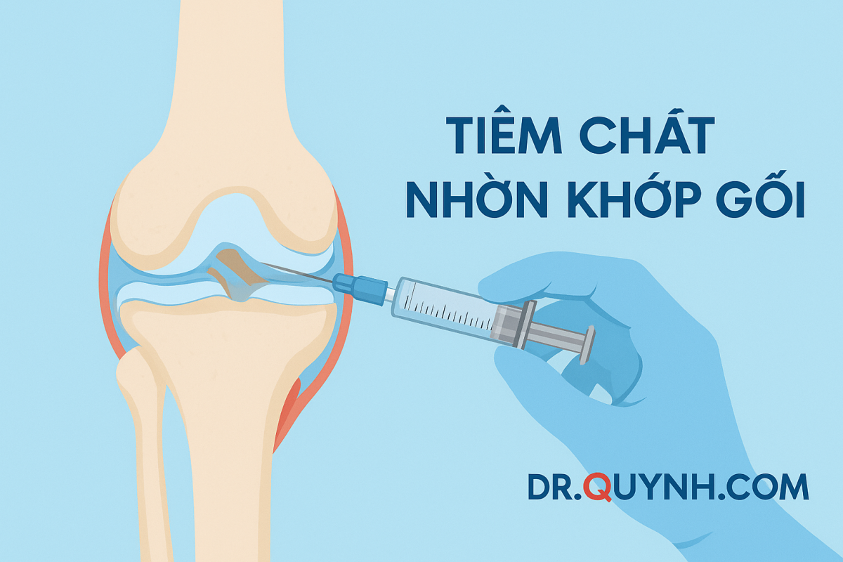Tiêm chất nhờn khớp gối: Giải pháp giảm đau an toàn và hiệu quả
