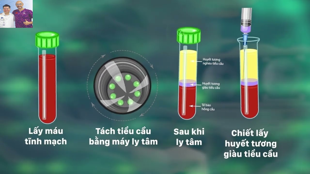tiêm huyết tương giàu tiểu