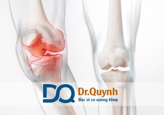 Quy trình tiêm chất nhờn khớp gối: hướng dẫn chi tiết từ A đến Z Quy trình tiêm chất nhờn khớp gối là một phương pháp điều trị hiện đại giúp cải thiện tình trạng thoái hóa khớp gối, giảm đau, tăng độ trơn tru cho khớp và phục hồi chức năng vận động.